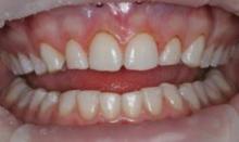 Inistant results. Only my gums were treated, now I can see more of my teeth.